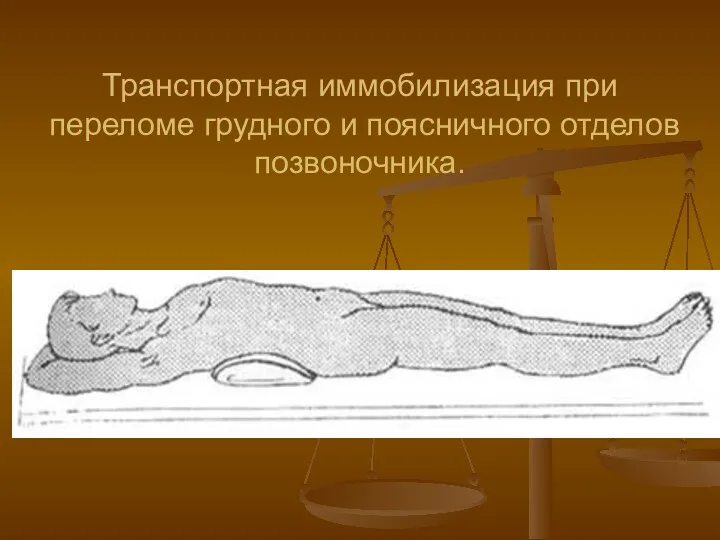 Транспортная иммобилизация при переломе грудного и поясничного отделов позвоночника.