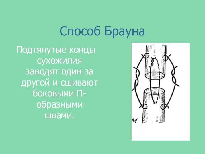 Способ Брауна Подтянутые концы сухожилия заводят один за другой и сшивают боковыми П-образными швами.