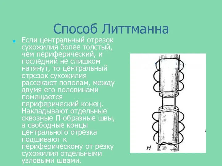 Способ Литтманна Если центральный отрезок сухожилия более толстый, чем периферический,