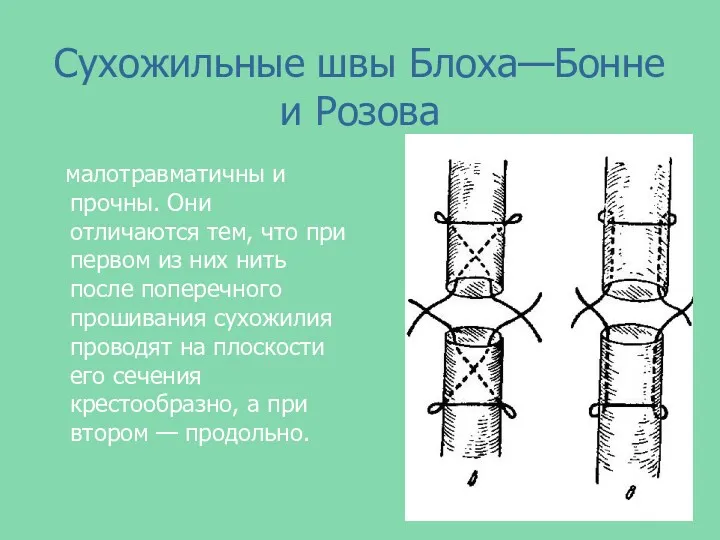 Сухожильные швы Блоха—Бонне и Розова малотравматичны и прочны. Они отличаются