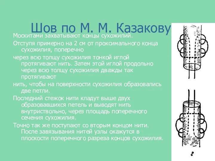 Шов по М. М. Казакову Москитами захватывают концы сухожилий. Отступя