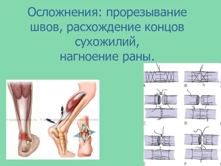 Осложнения: прорезывание швов, расхождение концов сухожилий, нагноение раны.