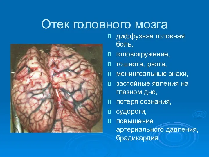 Отек головного мозга диффузная головная боль, головокружение, тошнота, рвота, менингеальные