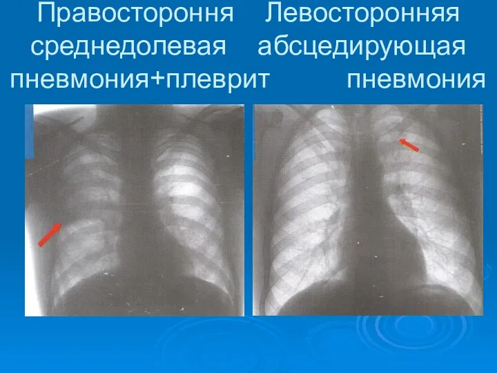 Правостороння Левосторонняя среднедолевая абсцедирующая пневмония+плеврит пневмония