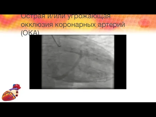 Острая и/или угрожающая окклюзия коронарных артерий (ОКА)