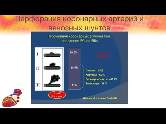 Перфорация коронарных артерий и венозных шунтов