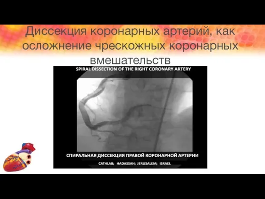 Диссекция коронарных артерий, как осложнение чрескожных коронарных вмешательств