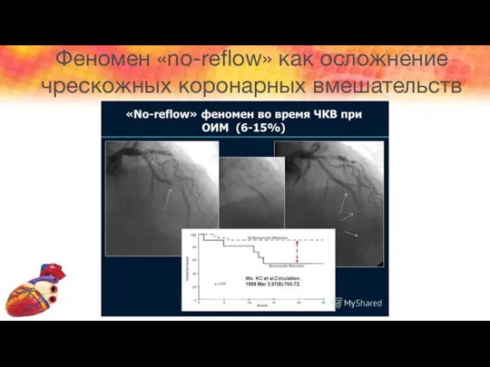 Феномен «no-reflow» как осложнение чрескожных коронарных вмешательств