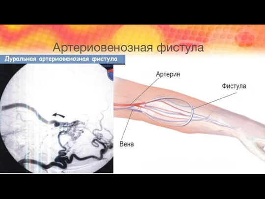 Артериовенозная фистула