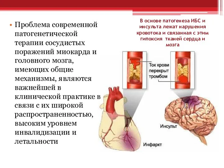 В основе патогенеза ИБС и инсульта лежат нарушения кровотока и