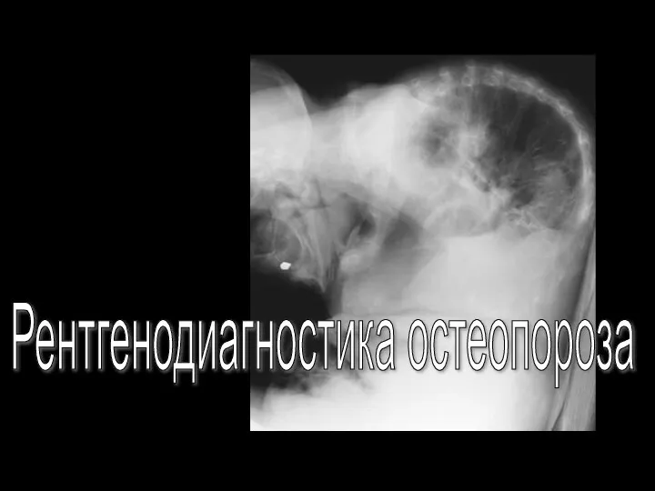 Рентгенодиагностика остеопороза