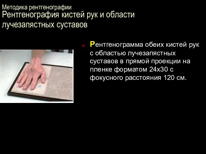 Методика рентгенографии Рентгенография кистей рук и области лучезапястных суставов Рентгенограмма обеих кистей рук