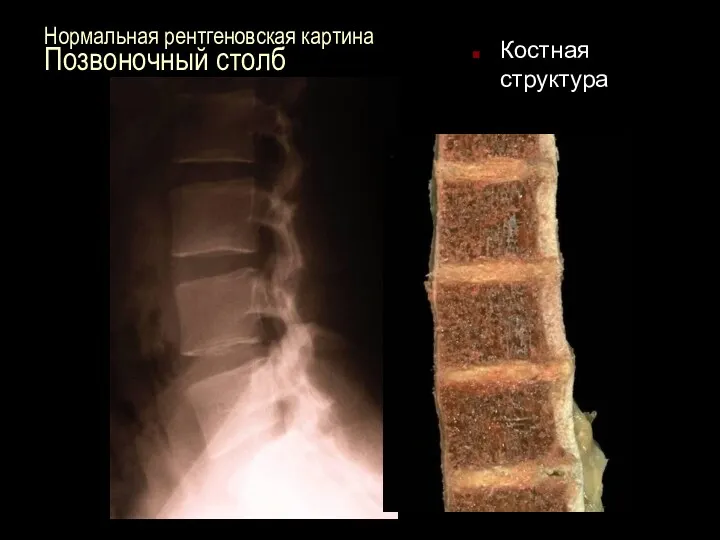 Нормальная рентгеновская картина Позвоночный столб Костная структура