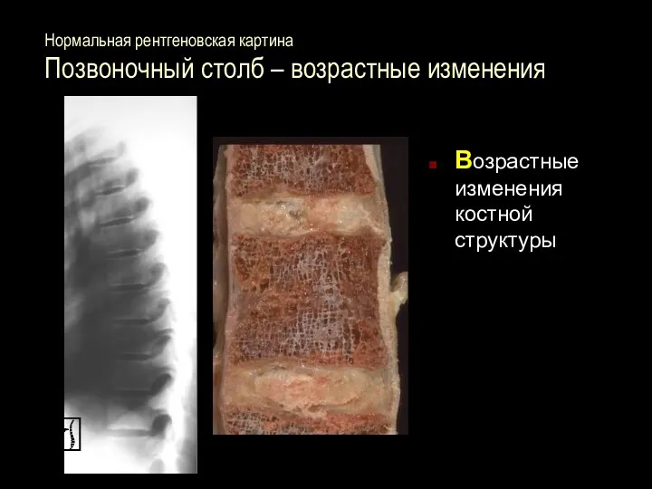 Нормальная рентгеновская картина Позвоночный столб – возрастные изменения Возрастные изменения костной структуры