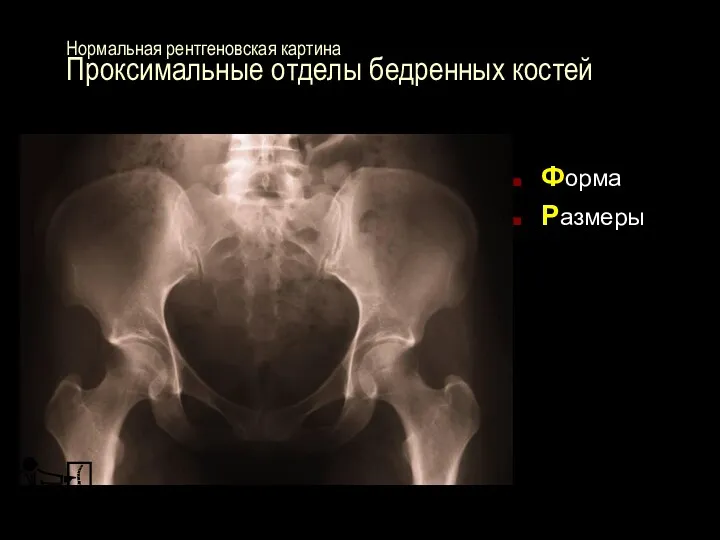 Форма Размеры Нормальная рентгеновская картина Проксимальные отделы бедренных костей