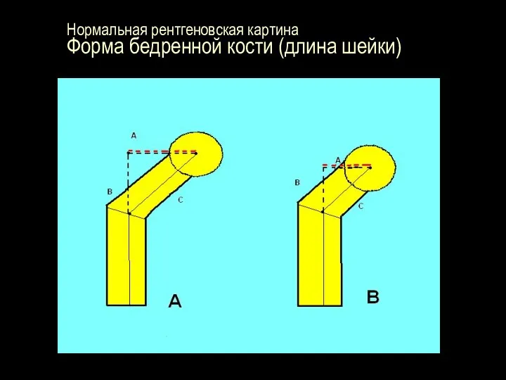 Нормальная рентгеновская картина Форма бедренной кости (длина шейки)