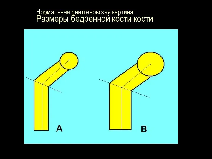 Нормальная рентгеновская картина Размеры бедренной кости кости