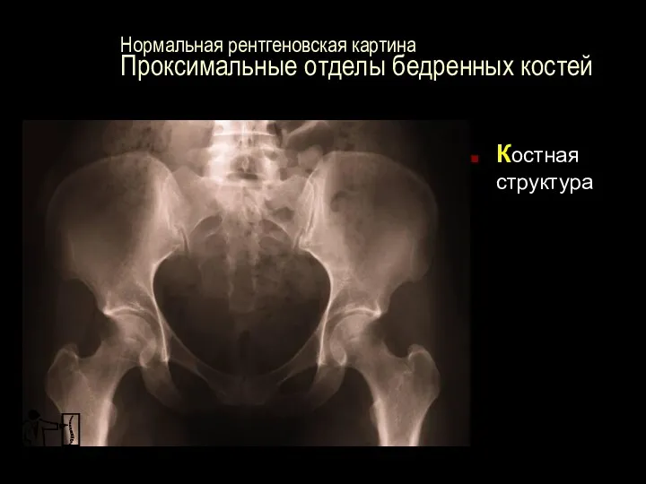 Нормальная рентгеновская картина Проксимальные отделы бедренных костей Костная структура