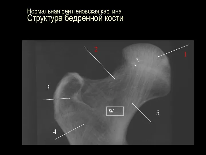 Нормальная рентгеновская картина Структура бедренной кости W 1 2 3 4 5