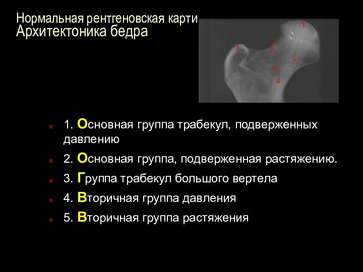 Нормальная рентгеновская картина Архитектоника бедра 1. Основная группа трабекул, подверженных