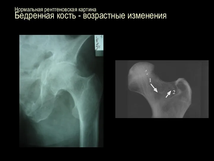 Нормальная рентгеновская картина Бедренная кость - возрастные изменения 1 2