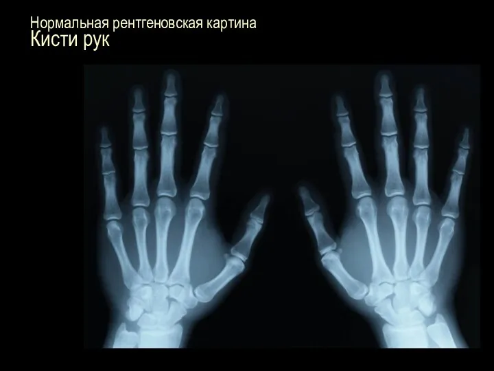 Нормальная рентгеновская картина Кисти рук