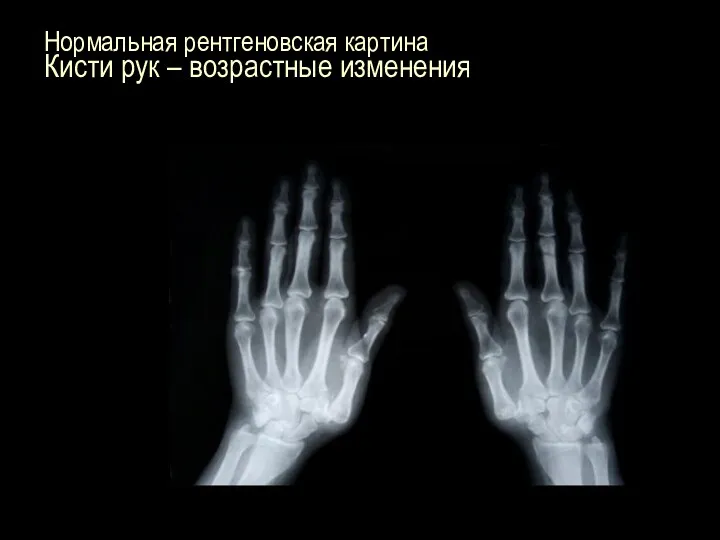Нормальная рентгеновская картина Кисти рук – возрастные изменения