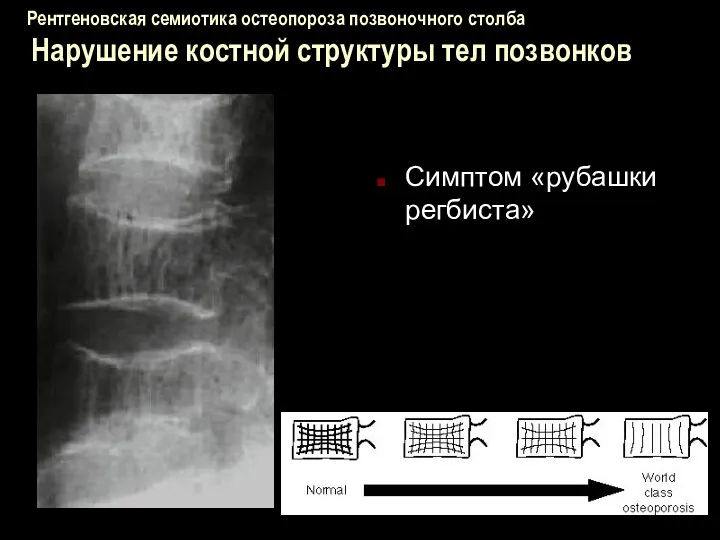 Рентгеновская семиотика остеопороза позвоночного столба Нарушение костной структуры тел позвонков Симптом «рубашки регбиста»