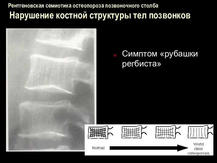 Рентгеновская семиотика остеопороза позвоночного столба Нарушение костной структуры тел позвонков Симптом «рубашки регбиста»
