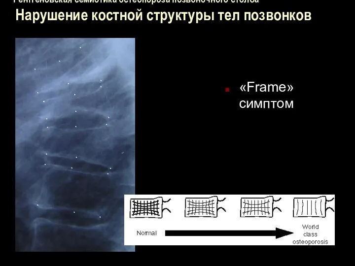 Рентгеновская семиотика остеопороза позвоночного столба Нарушение костной структуры тел позвонков «Frame» симптом