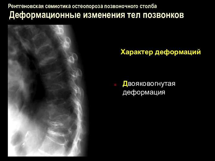 Рентгеновская семиотика остеопороза позвоночного столба Деформационные изменения тел позвонков Характер деформаций Двояковогнутая деформация