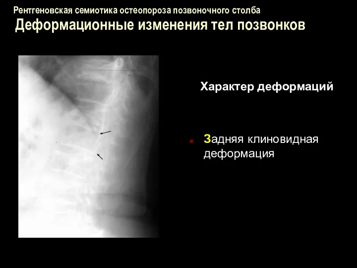 Рентгеновская семиотика остеопороза позвоночного столба Деформационные изменения тел позвонков Характер деформаций Задняя клиновидная деформация