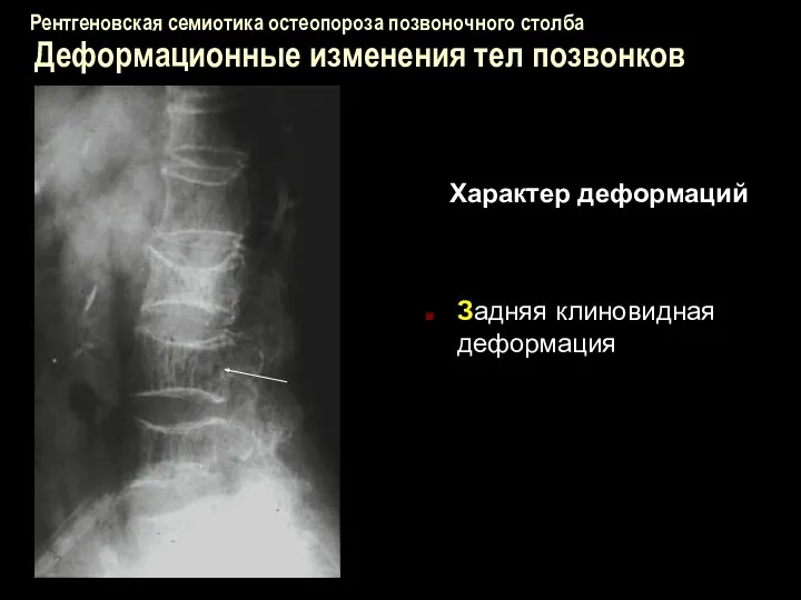 Рентгеновская семиотика остеопороза позвоночного столба Деформационные изменения тел позвонков Характер деформаций Задняя клиновидная деформация