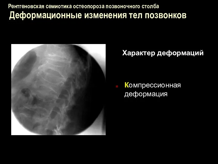Рентгеновская семиотика остеопороза позвоночного столба Деформационные изменения тел позвонков Характер деформаций Компрессионная деформация