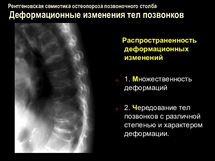 Рентгеновская семиотика остеопороза позвоночного столба Деформационные изменения тел позвонков Распространенность деформационных изменений 1.