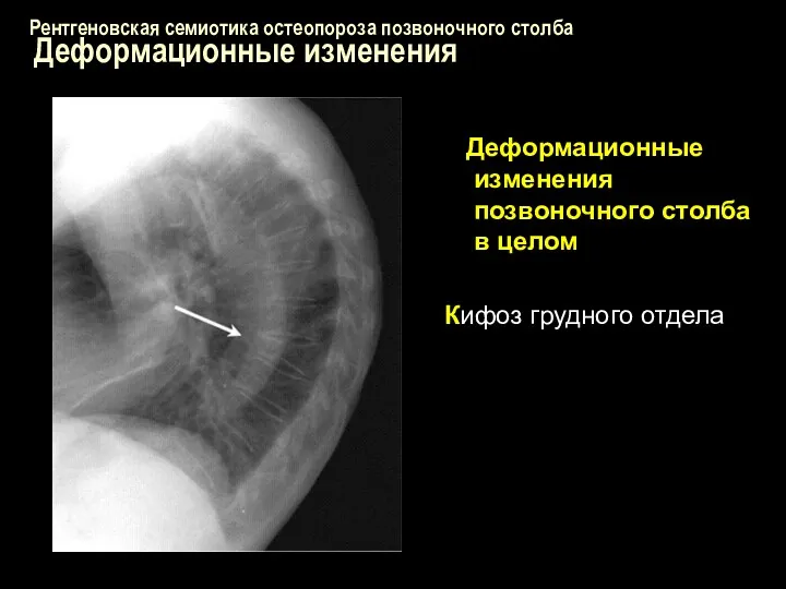 Рентгеновская семиотика остеопороза позвоночного столба Деформационные изменения Деформационные изменения позвоночного столба в целом Кифоз грудного отдела