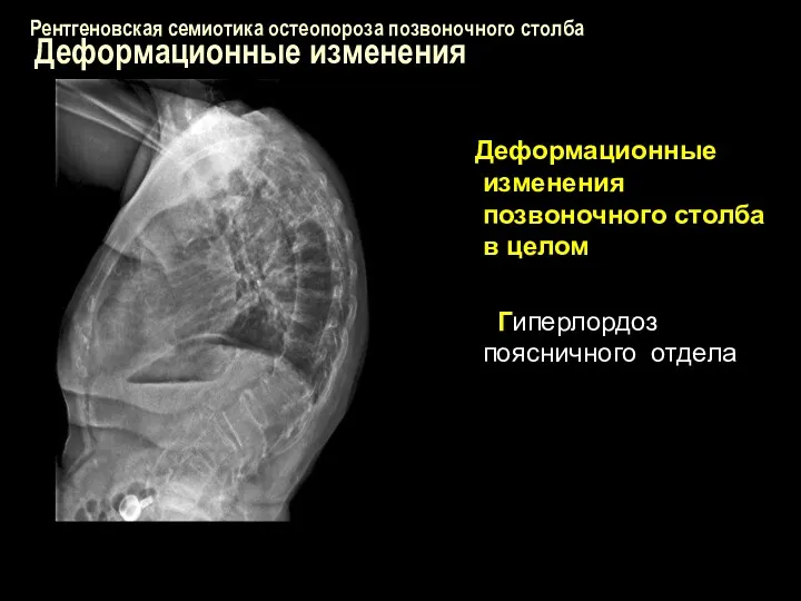 Рентгеновская семиотика остеопороза позвоночного столба Деформационные изменения Деформационные изменения позвоночного столба в целом Гиперлордоз поясничного отдела