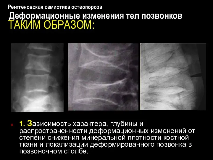 Рентгеновская семиотика остеопороза Деформационные изменения тел позвонков ТАКИМ ОБРАЗОМ: 1. Зависимость характера, глубины