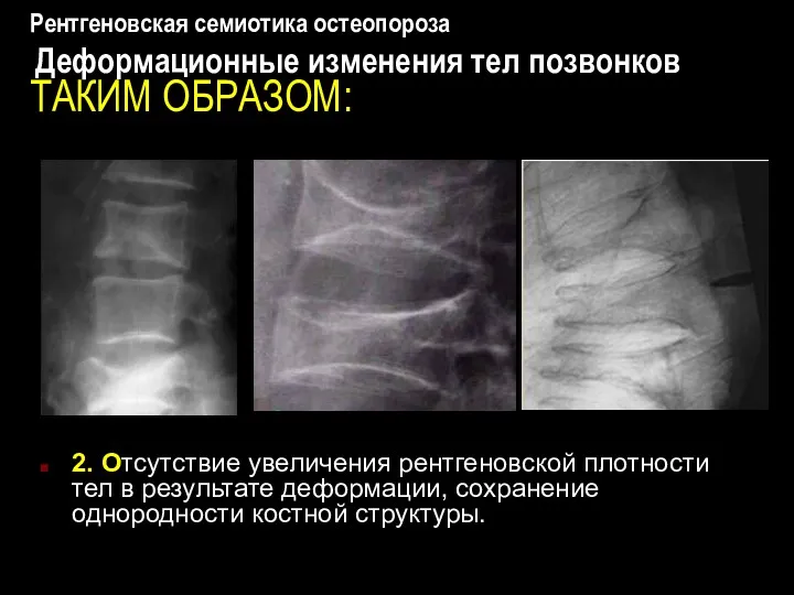 Рентгеновская семиотика остеопороза Деформационные изменения тел позвонков ТАКИМ ОБРАЗОМ: 2. Отсутствие увеличения рентгеновской