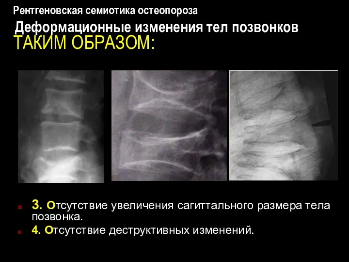 Рентгеновская семиотика остеопороза Деформационные изменения тел позвонков ТАКИМ ОБРАЗОМ: 3.