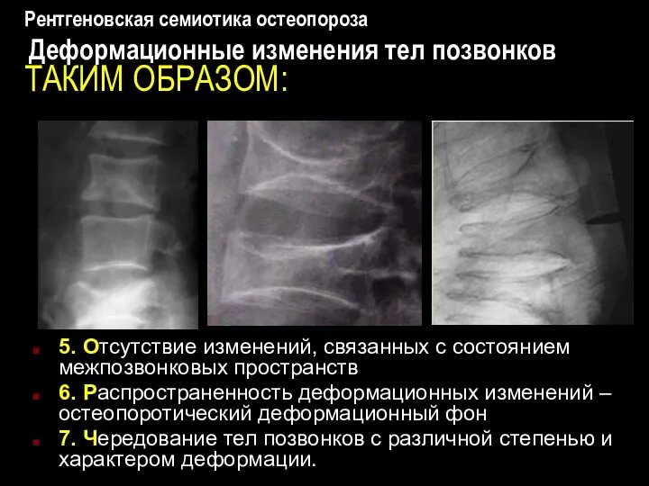 Рентгеновская семиотика остеопороза Деформационные изменения тел позвонков ТАКИМ ОБРАЗОМ: 5. Отсутствие изменений, связанных