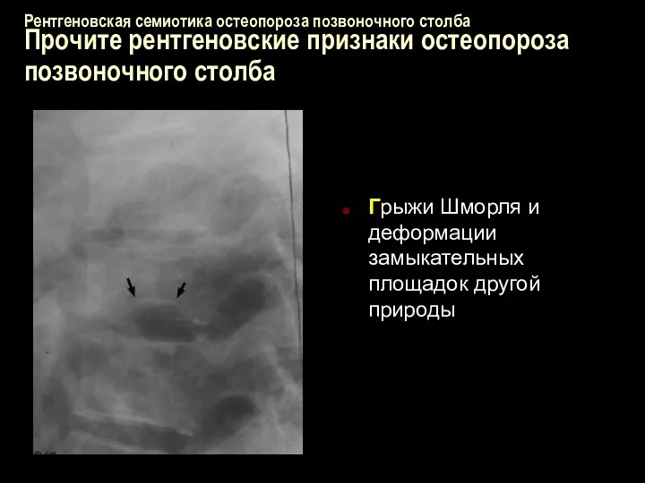 Рентгеновская семиотика остеопороза позвоночного столба Прочите рентгеновские признаки остеопороза позвоночного столба Грыжи Шморля