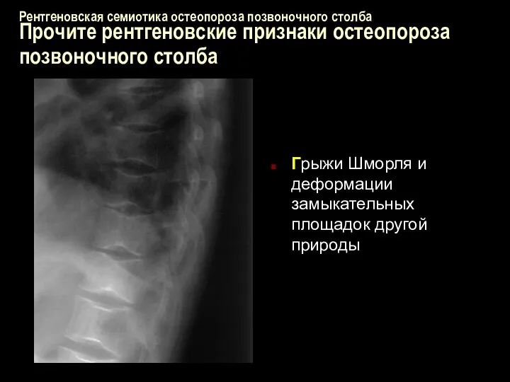 Рентгеновская семиотика остеопороза позвоночного столба Прочите рентгеновские признаки остеопороза позвоночного столба Грыжи Шморля