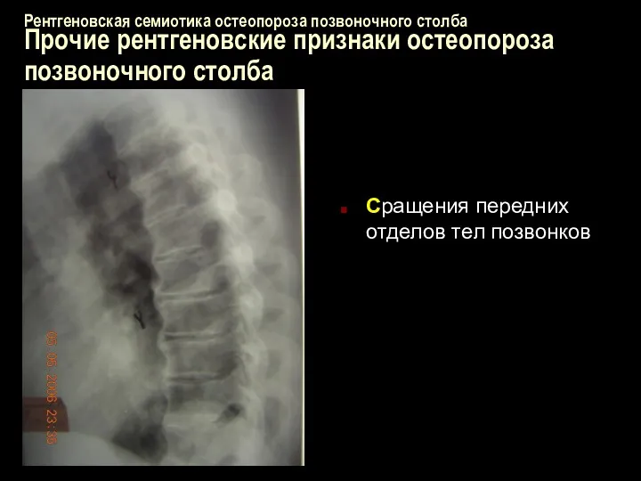 Рентгеновская семиотика остеопороза позвоночного столба Прочие рентгеновские признаки остеопороза позвоночного столба Сращения передних отделов тел позвонков