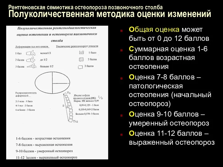 Рентгеновская семиотика остеопороза позвоночного столба Полуколичественная методика оценки изменений Общая оценка может быть