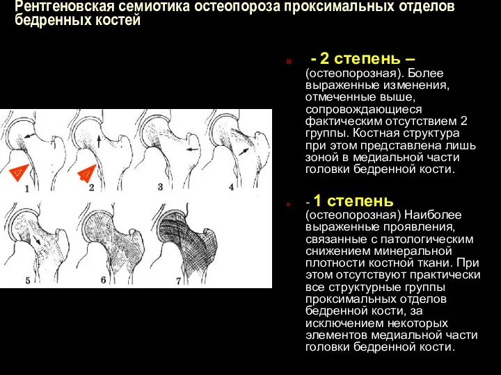 Рентгеновская семиотика остеопороза проксимальных отделов бедренных костей - 2 степень – (остеопорозная). Более