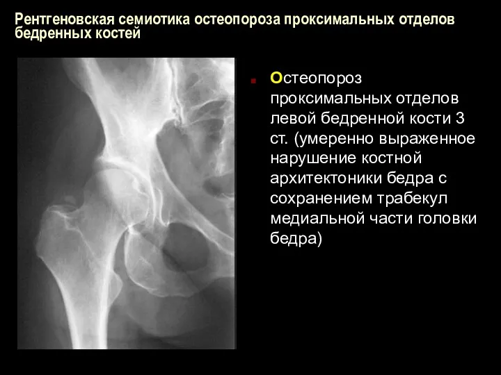 Рентгеновская семиотика остеопороза проксимальных отделов бедренных костей Остеопороз проксимальных отделов левой бедренной кости