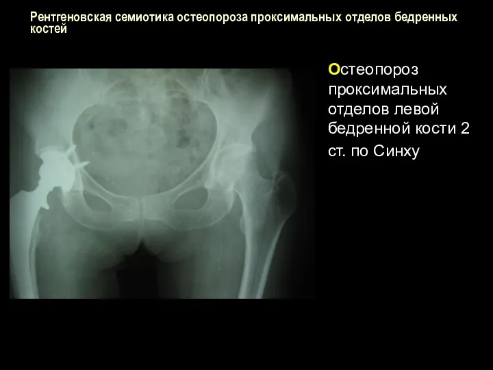 Рентгеновская семиотика остеопороза проксимальных отделов бедренных костей Остеопороз проксимальных отделов левой бедренной кости