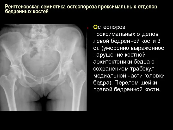 Рентгеновская семиотика остеопороза проксимальных отделов бедренных костей Остеопороз проксимальных отделов левой бедренной кости