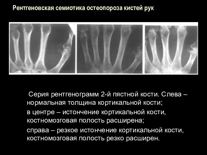 Рентгеновская семиотика остеопороза кистей рук Серия рентгенограмм 2-й пястной кости.